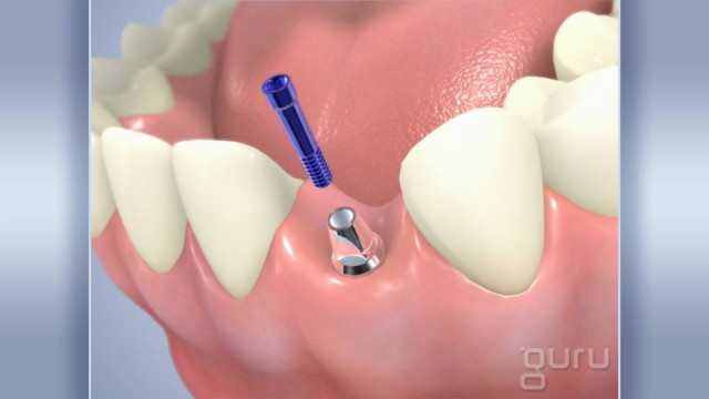 Implant Incisor